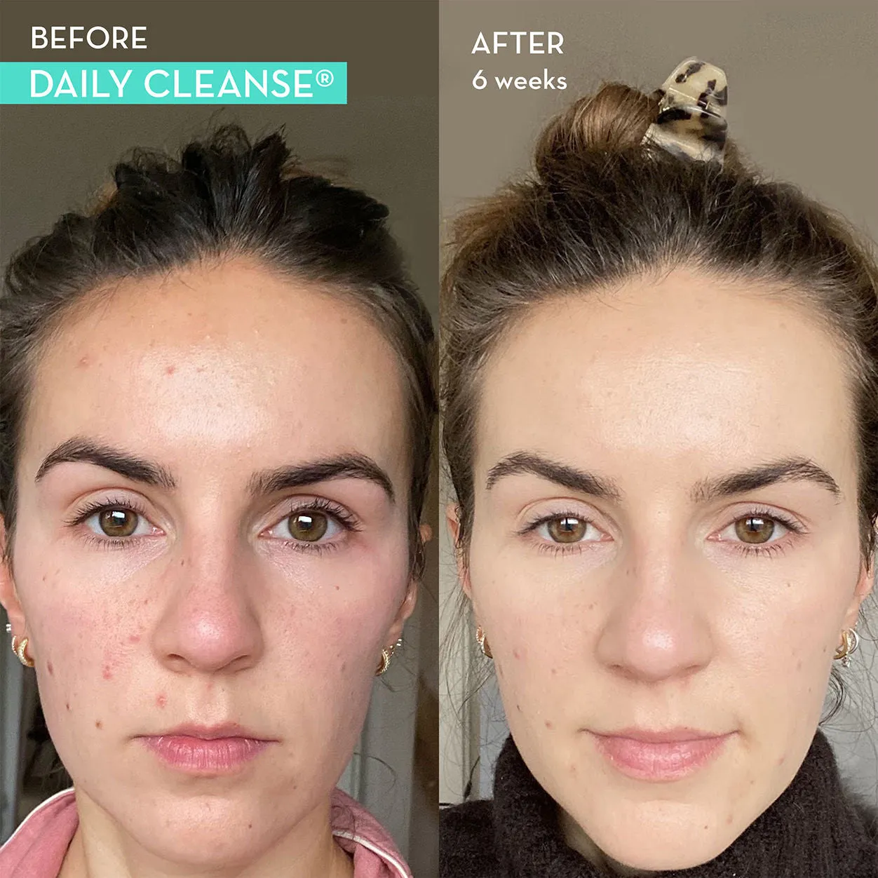 Daily Cleanse Clear Skin and Acne Supplement